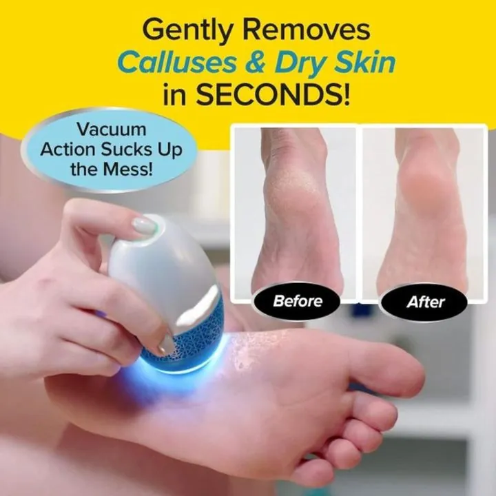 جهاز إزالة الجلد الميت وتشقق القدمين مع شفط وفلتر Rechargeable Callus Remover with Vacuum &amp; LED Light — 3